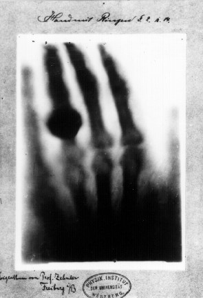 First x-ray image by Röntgen