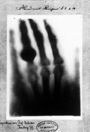 first x-ray image by röntgen